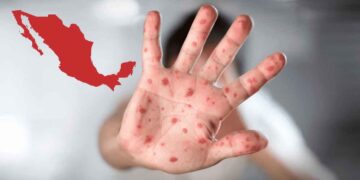 México certificación sarampión