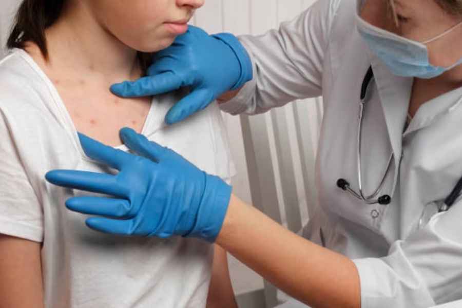 Secretaría de Salud reporta baja en casos de sarampión, pero mantiene alerta sanitaria
