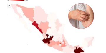 brote de sarampión en México
