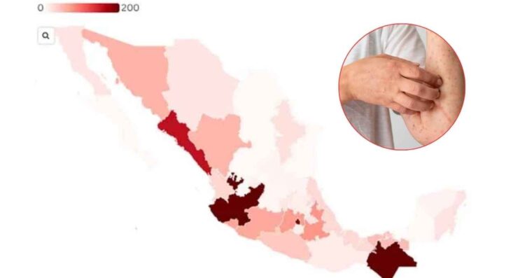 brote de sarampión en México