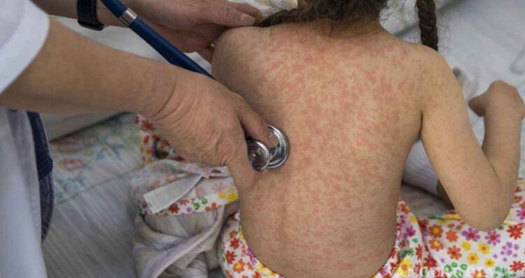 Repunte de sarampión suma casi mil casos en México en febrero
