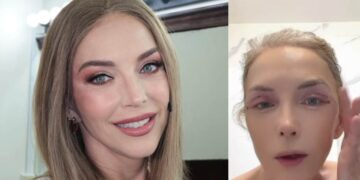 Laura Flores se somete a cirugía estética y explica cómo va su recuperación