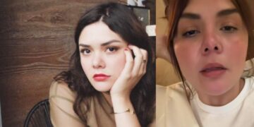 Yuridia revela que un tratamiento le dejó una cicatriz en el rostro