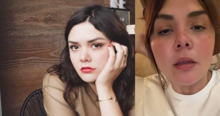 Yuridia revela que un tratamiento le dejó una cicatriz en el rostro