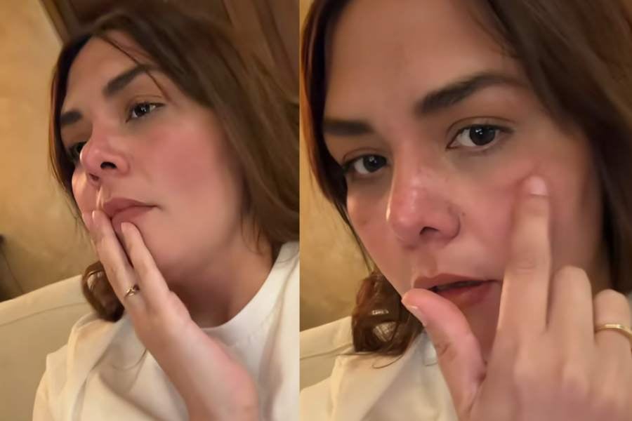 Yuridia revela que un tratamiento le dejó una cicatriz en el rostro
