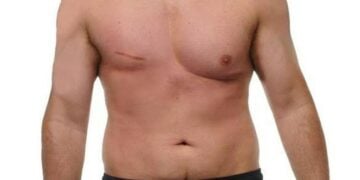 cáncer de mama en hombres en Tampico
