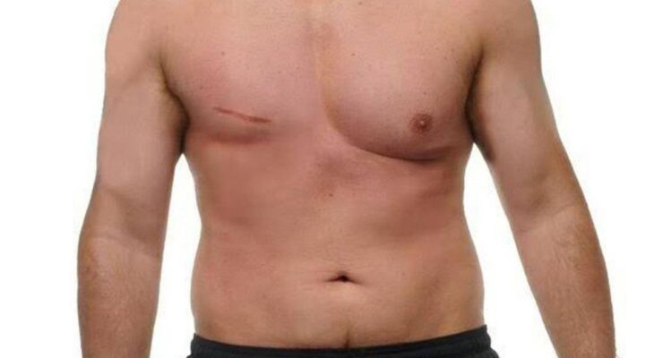 cáncer de mama en hombres en Tampico